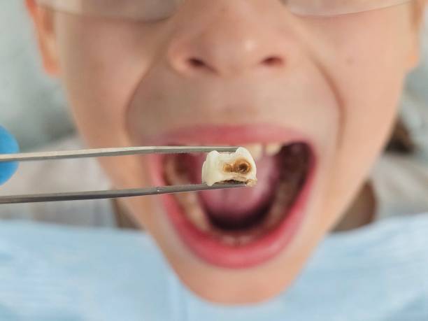 Best Emergency Wisdom Tooth Extraction in Burwell, NE